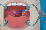 Tonsil Surgery